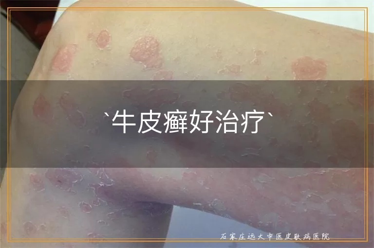牛皮癣好治疗