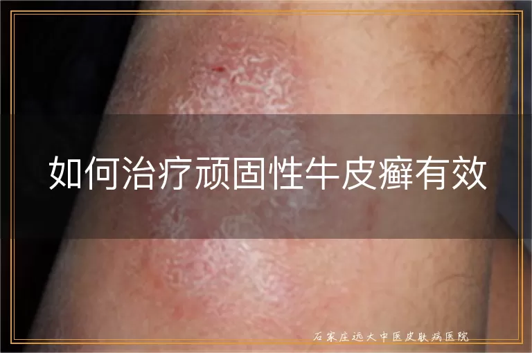 如何治疗顽固性牛皮癣有效
