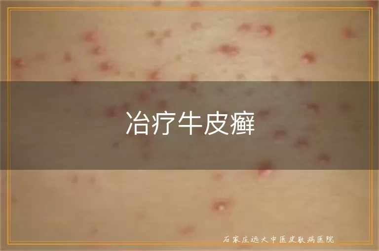冶疗牛皮癣