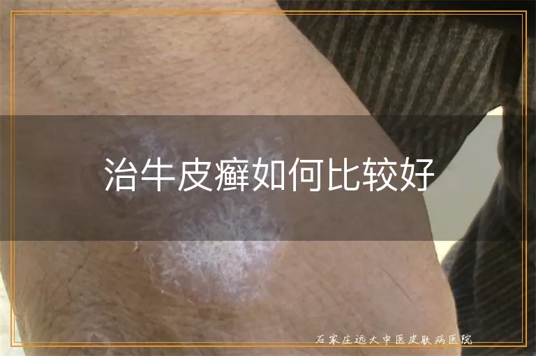 治牛皮癣如何比较好