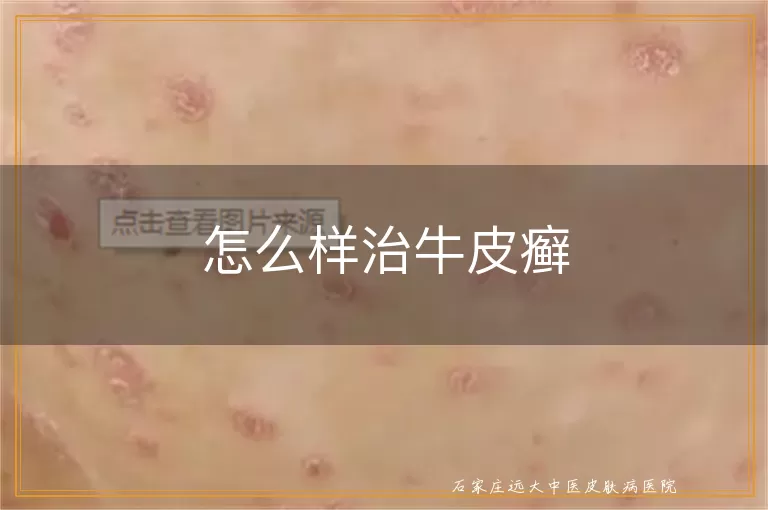 怎么样治牛皮癣
