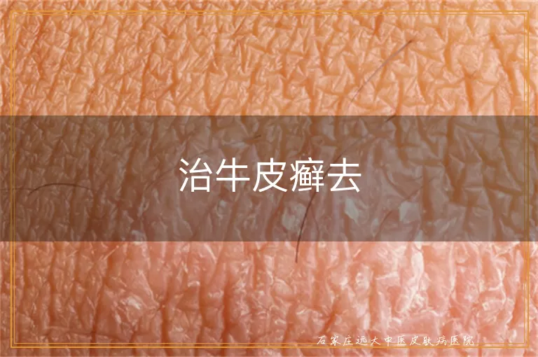 治牛皮癣去