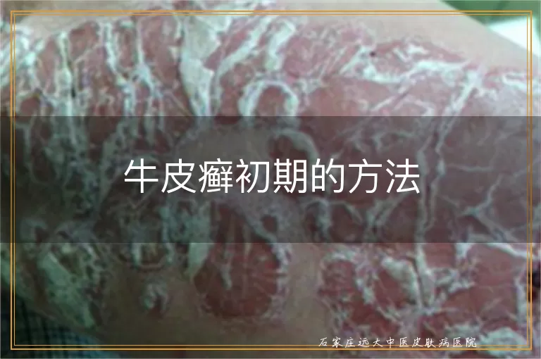 牛皮癣初期的方法