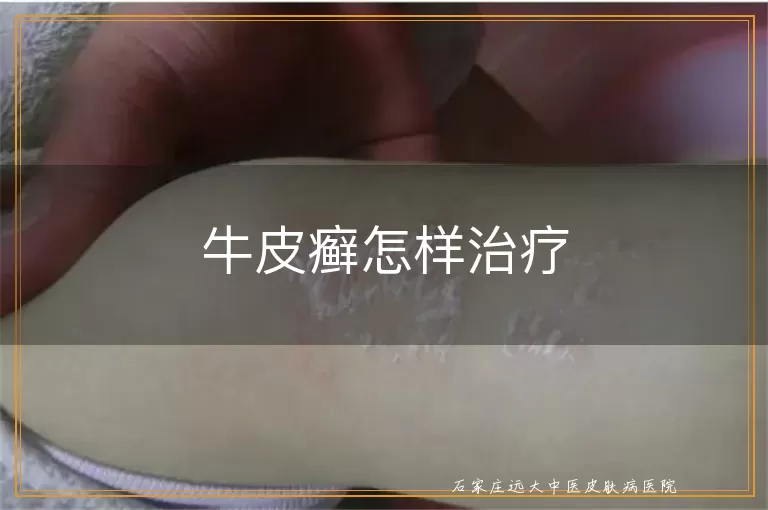 牛皮癣怎样治疗