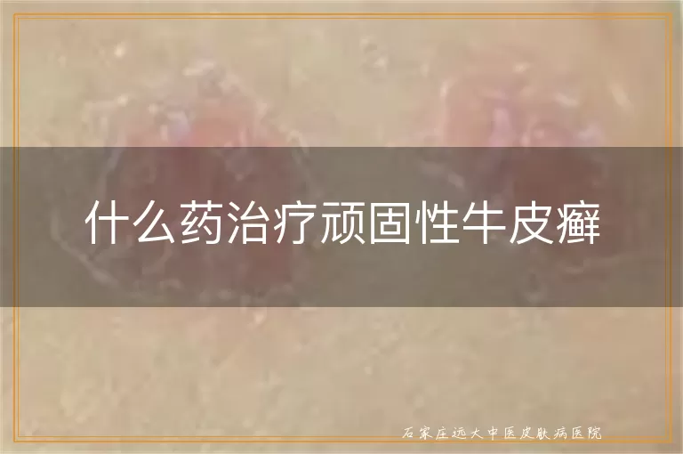 什么药治疗顽固性牛皮癣
