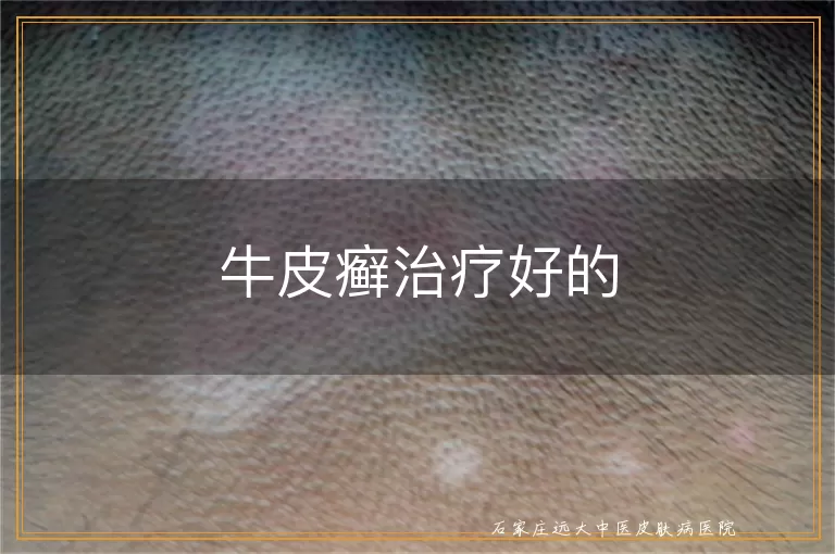 牛皮癣治疗好的