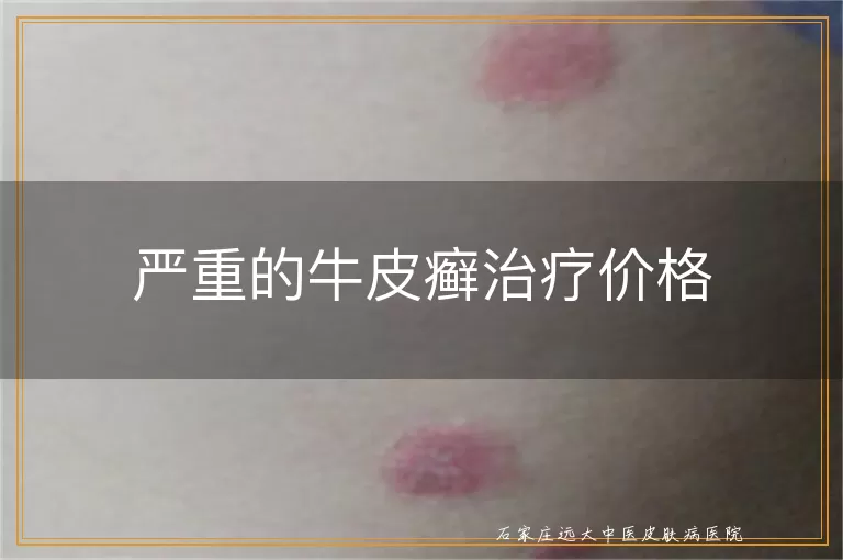 严重的牛皮癣治疗价格
