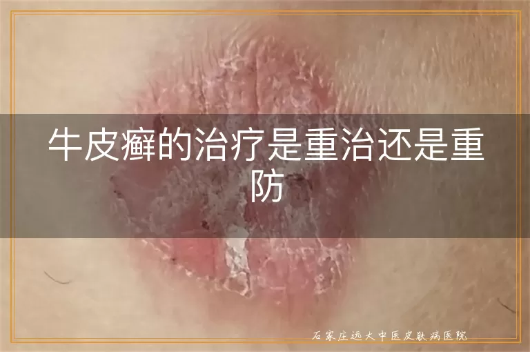 牛皮癣的治疗是重治还是重防