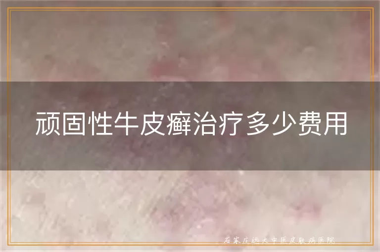 顽固性牛皮癣治疗多少费用