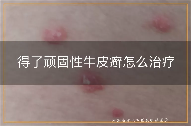 得了顽固性牛皮癣怎么治疗