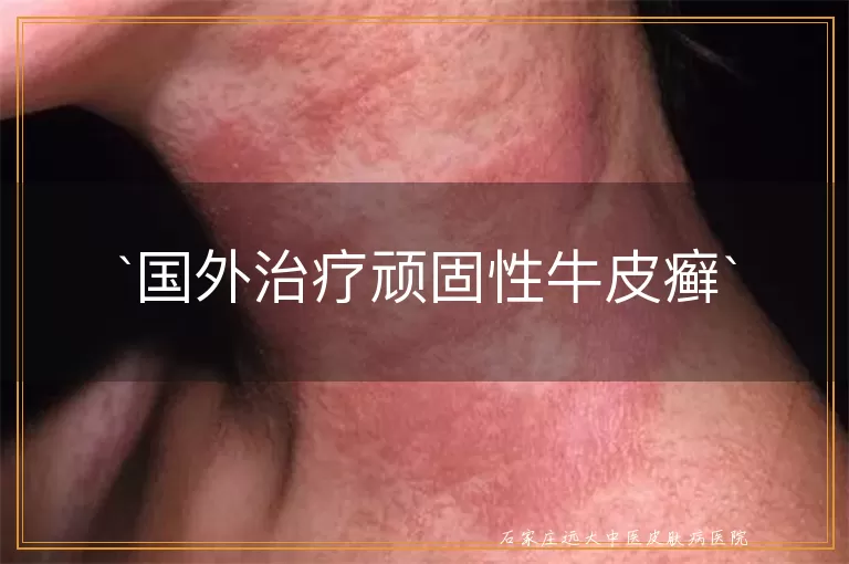 国外治疗顽固性牛皮癣