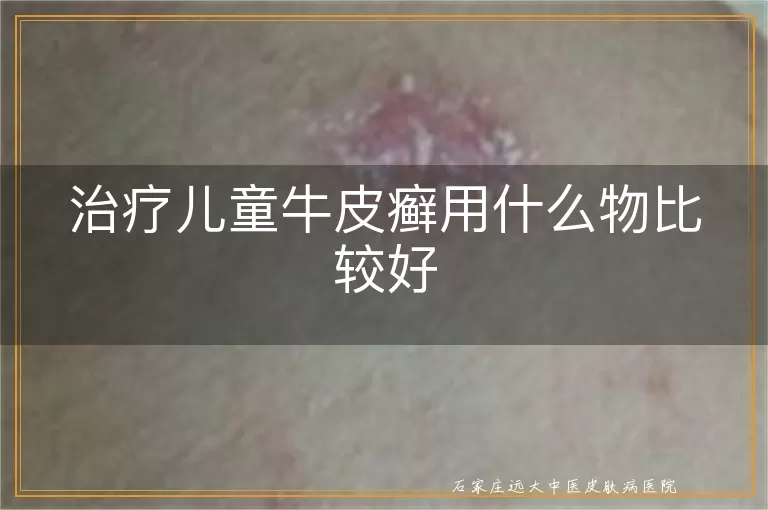 治疗儿童牛皮癣用什么物比较好