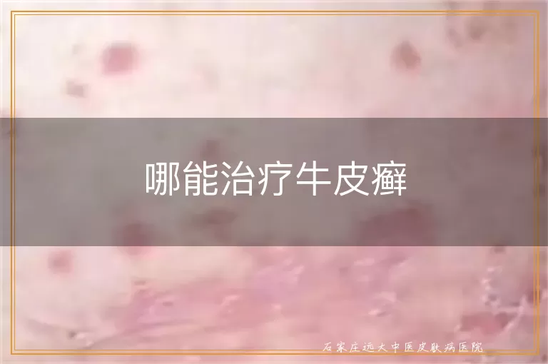 哪能治疗牛皮癣