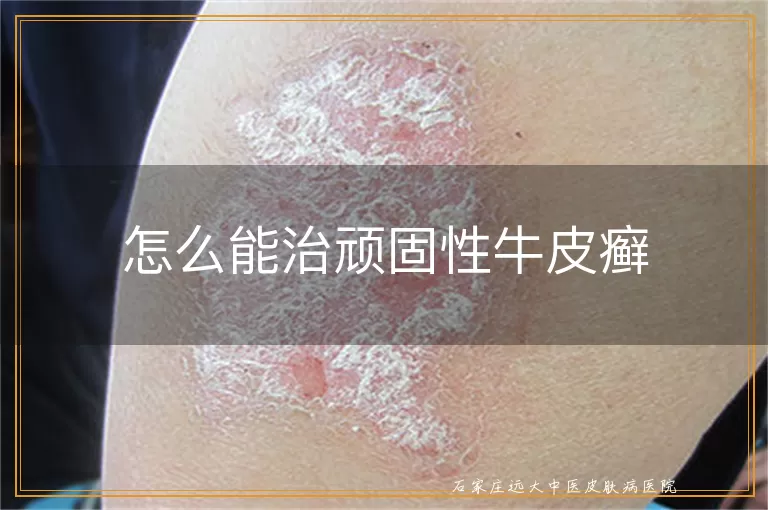 怎么能治顽固性牛皮癣