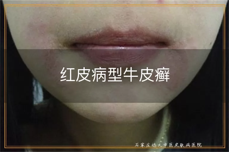 红皮病型牛皮癣