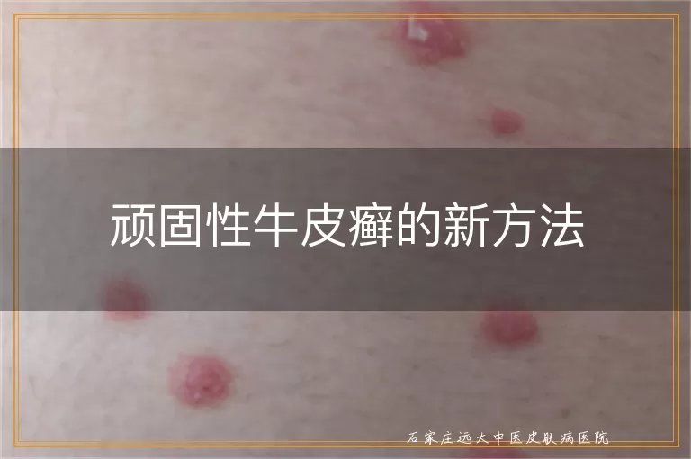 顽固性牛皮癣的新方法