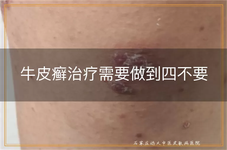 牛皮癣治疗需要做到四不要