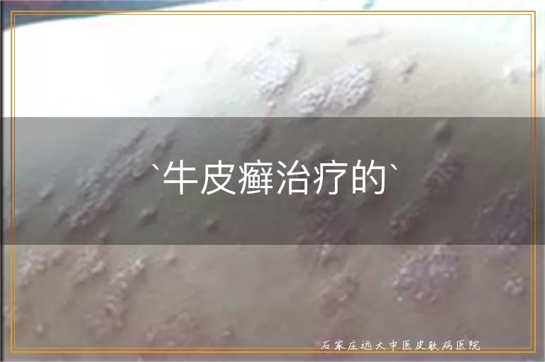 牛皮癣治疗的