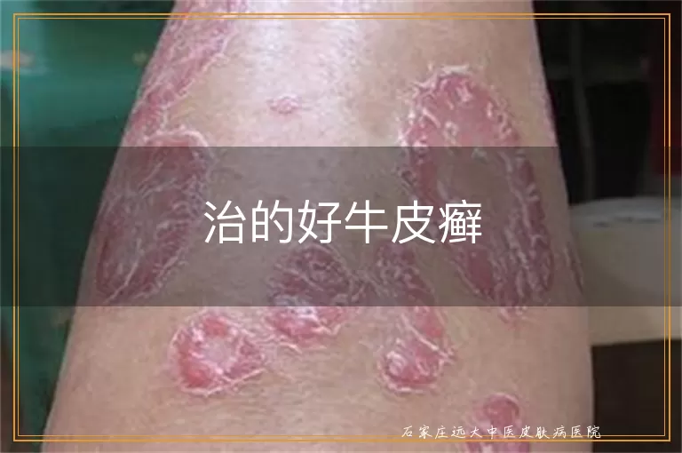 治的好牛皮癣