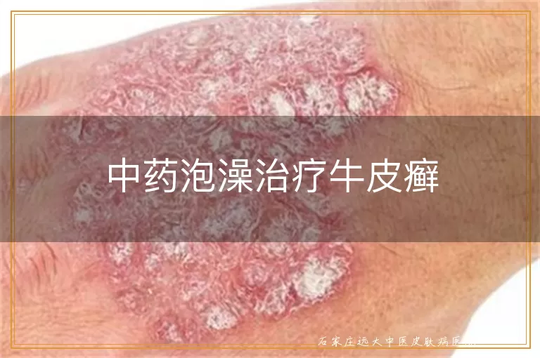 中药泡澡治疗牛皮癣