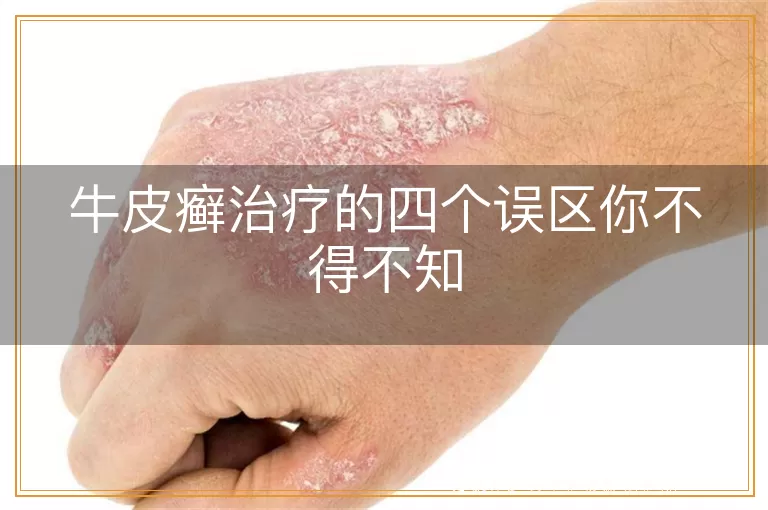 牛皮癣治疗的四个误区你不得不知
