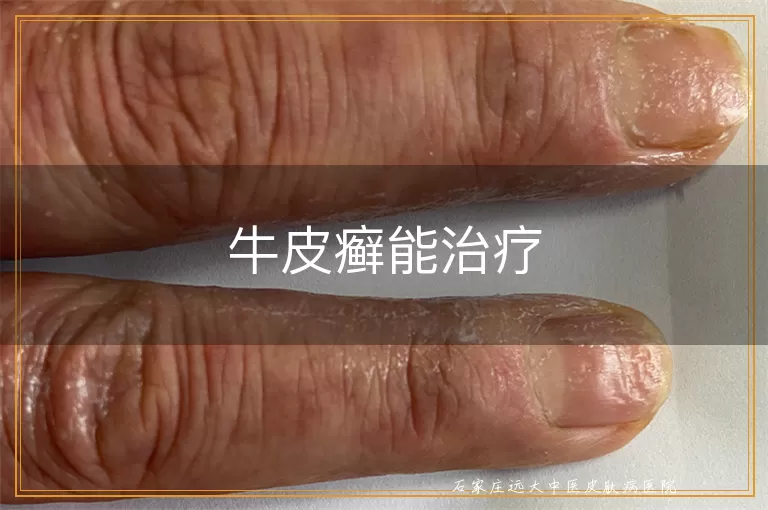 牛皮癣能治疗