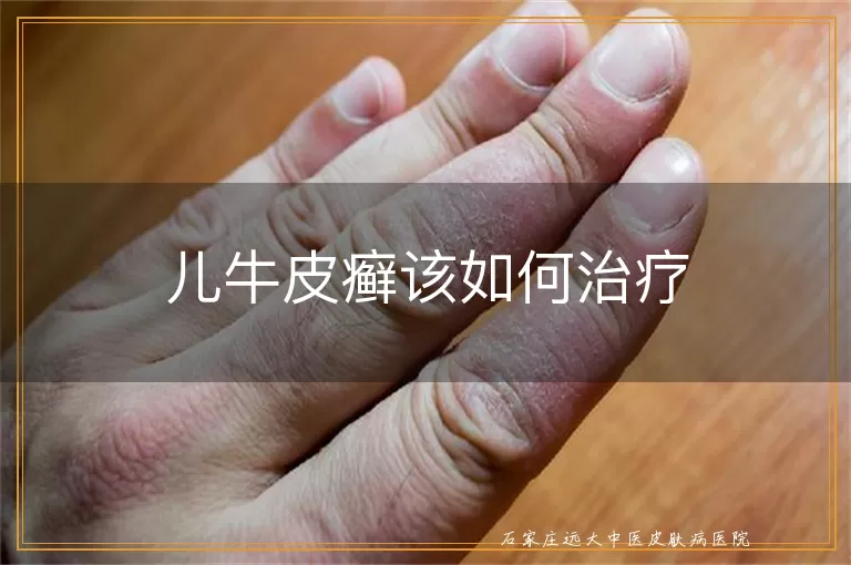 儿牛皮癣该如何治疗