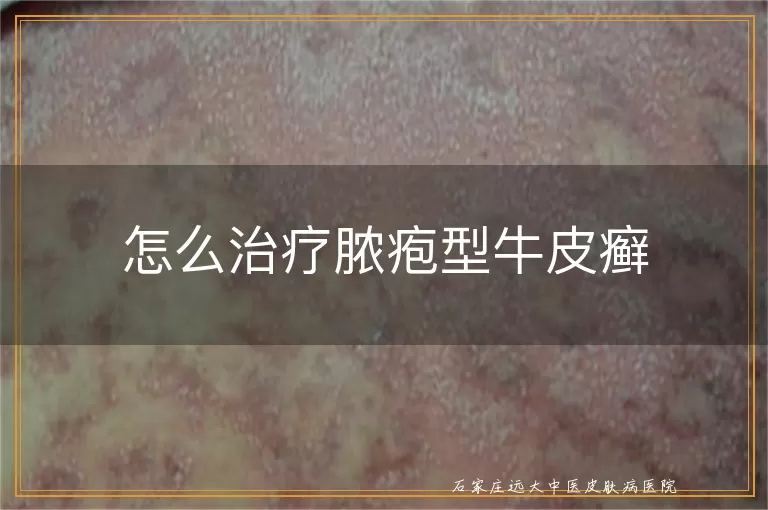 怎么治疗脓疱型牛皮癣
