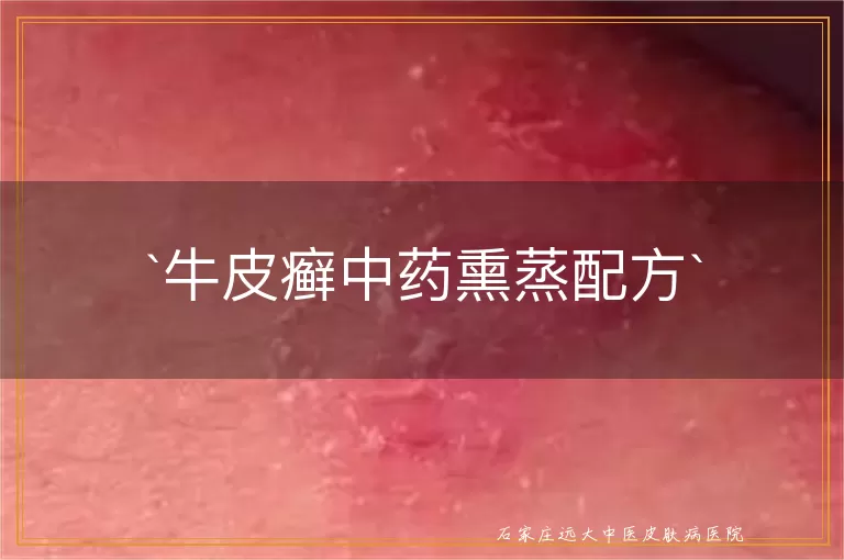 牛皮癣中药熏蒸配方