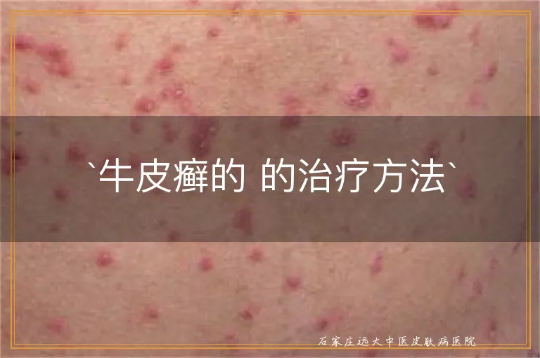 牛皮癣的 的治疗方法