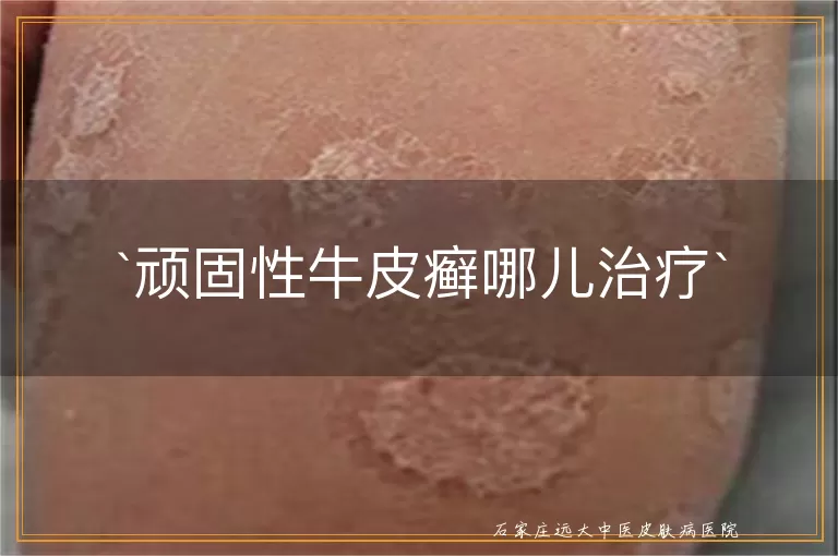 顽固性牛皮癣哪儿治疗