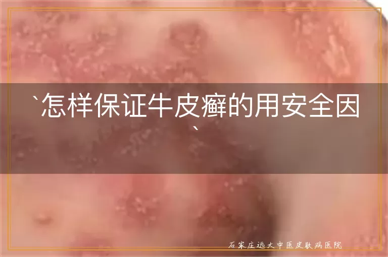 怎样保证牛皮癣的用安全因