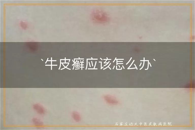 牛皮癣应该怎么办