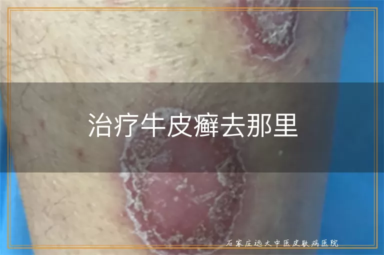 治疗牛皮癣去那里