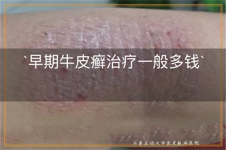 早期牛皮癣治疗一般多钱