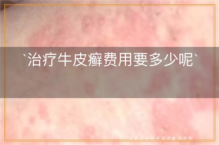 治疗牛皮癣费用要多少呢