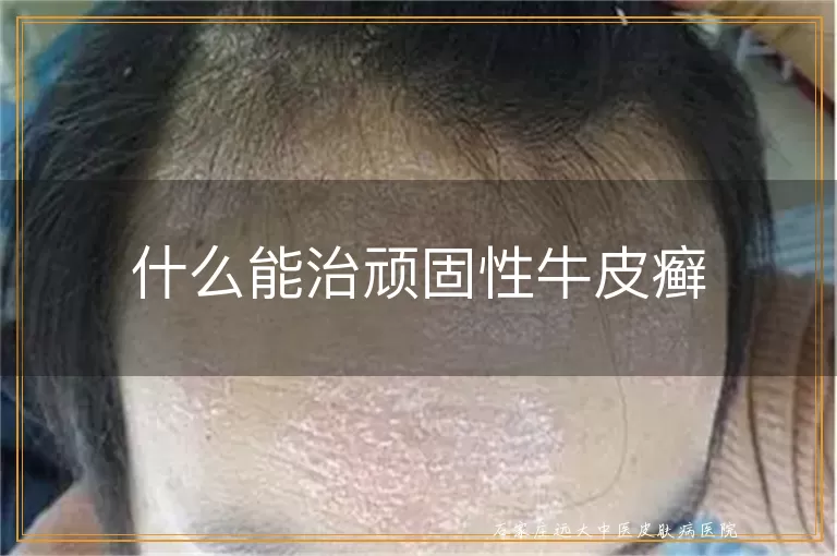 什么能治顽固性牛皮癣