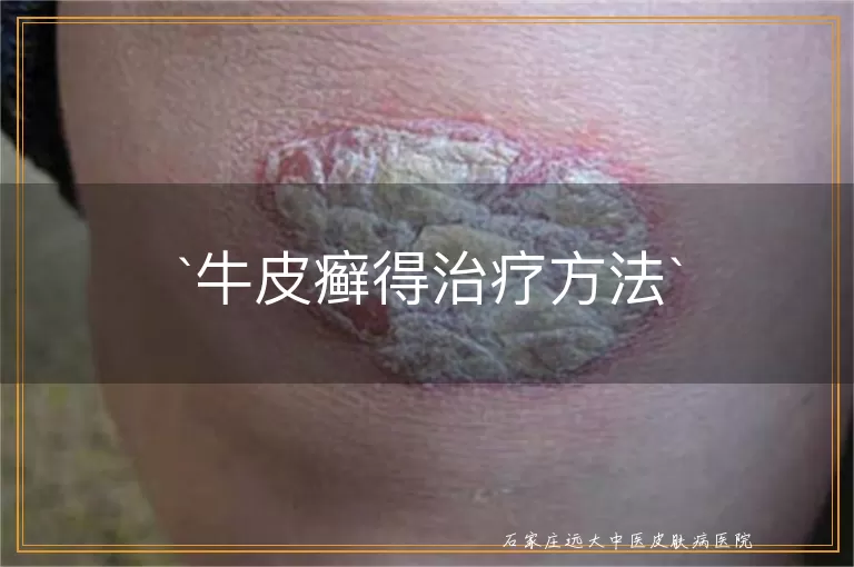 牛皮癣得治疗方法