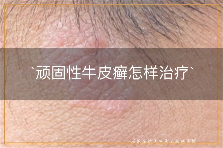 顽固性牛皮癣怎样治疗