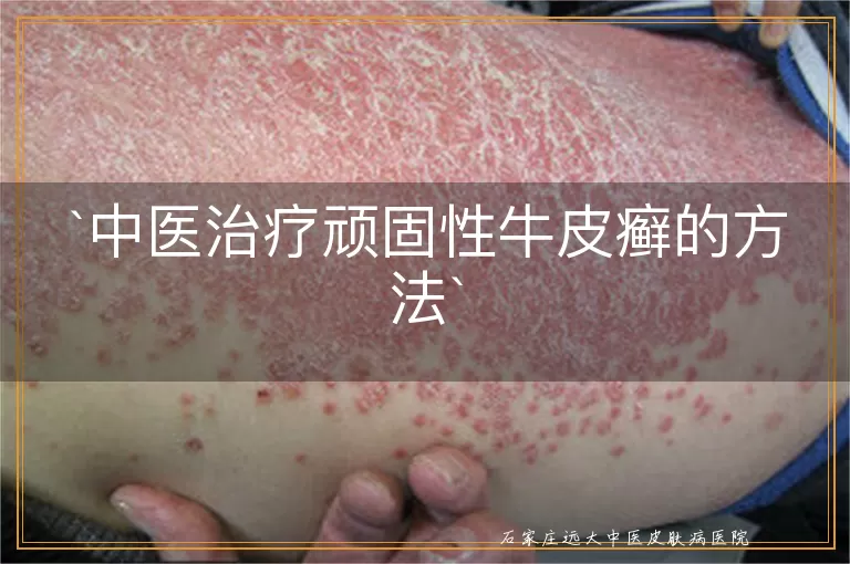 中医治疗顽固性牛皮癣的方法
