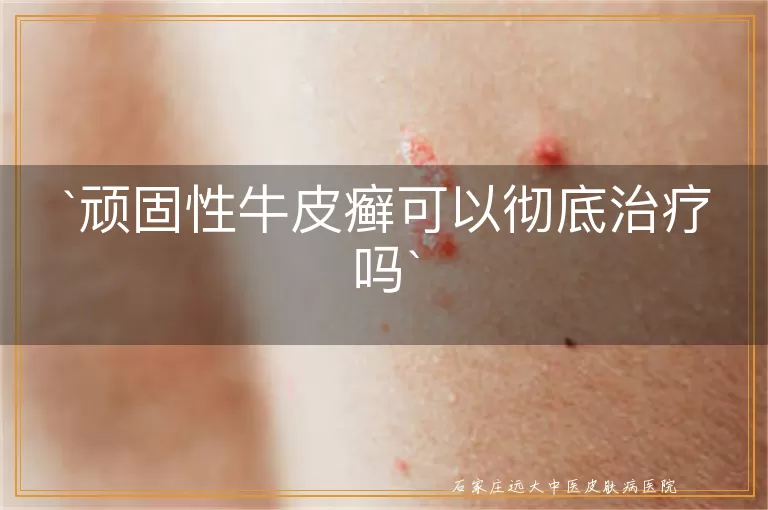 顽固性牛皮癣可以彻底治疗吗