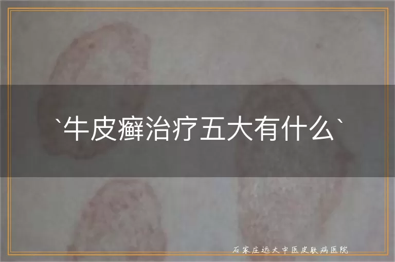 牛皮癣治疗五大有什么