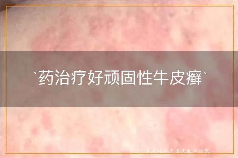 药治疗好顽固性牛皮癣