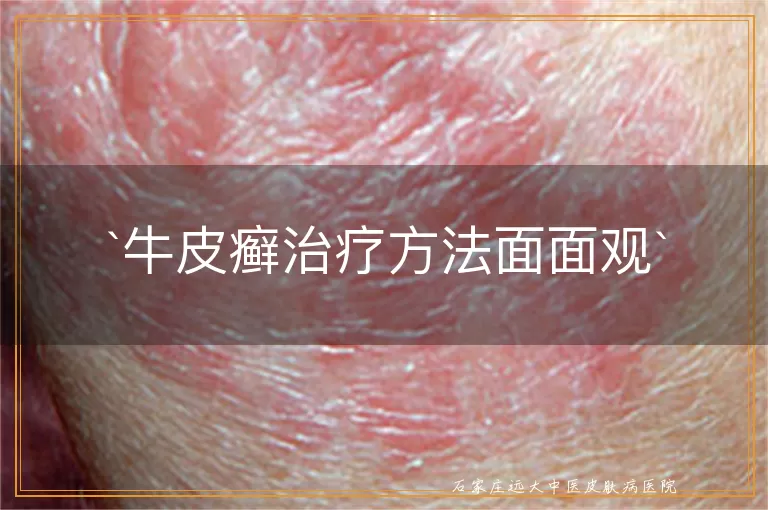 牛皮癣治疗方法面面观