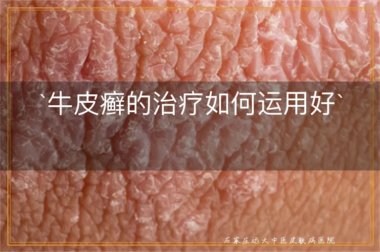 牛皮癣的治疗如何运用好