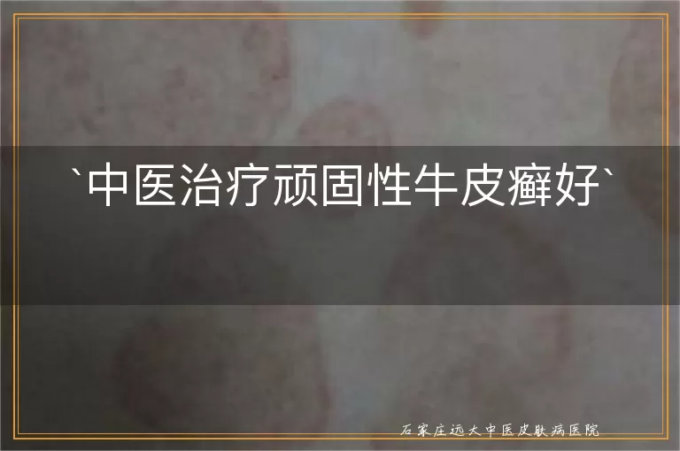 中医治疗顽固性牛皮癣好