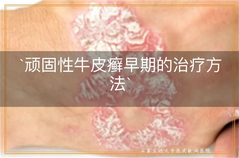 顽固性牛皮癣早期的治疗方法