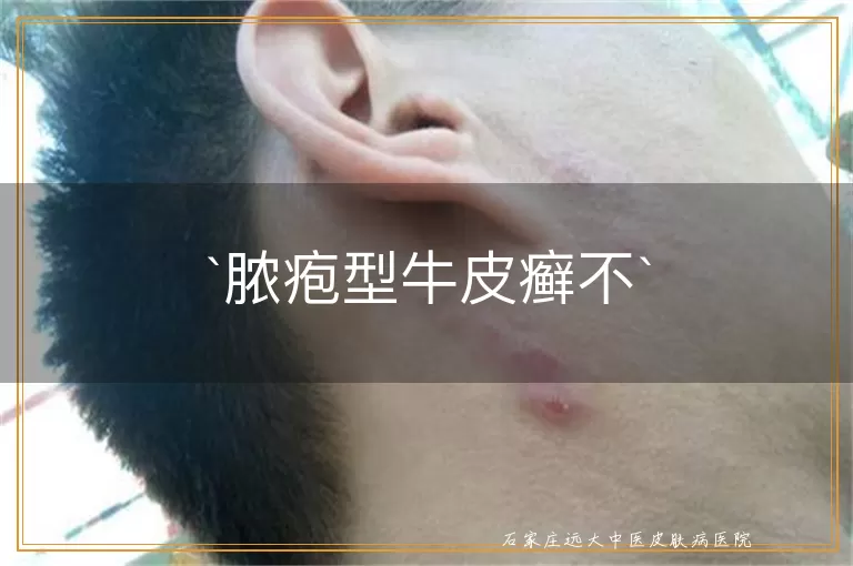 脓疱型牛皮癣不