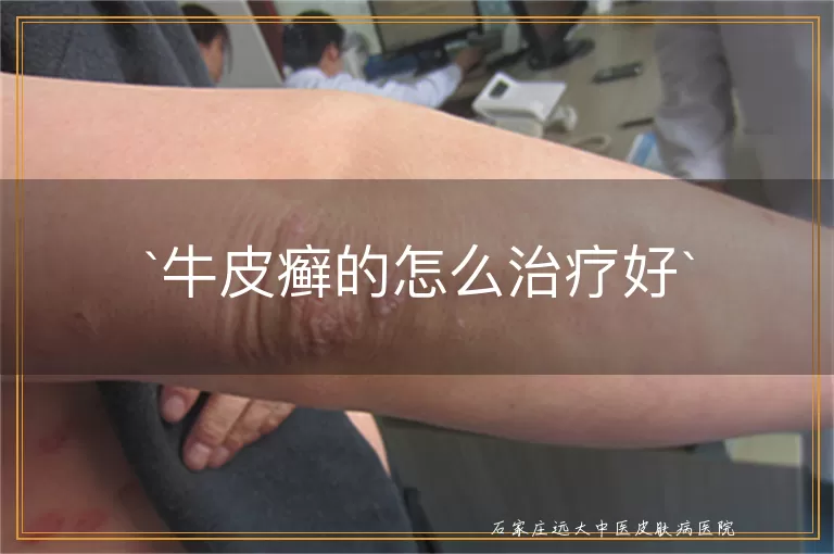 牛皮癣的怎么治疗好