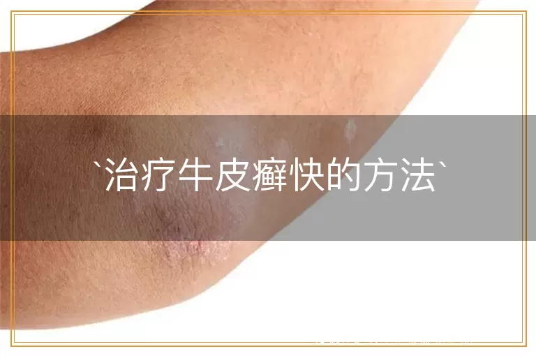 治疗牛皮癣快的方法